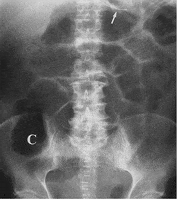 Laparoscopy
